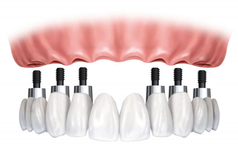 Pròtesi dentals
