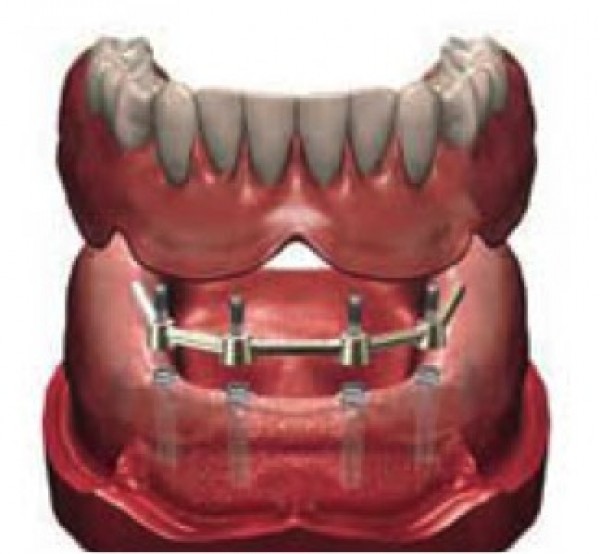 Pròtesi dentals